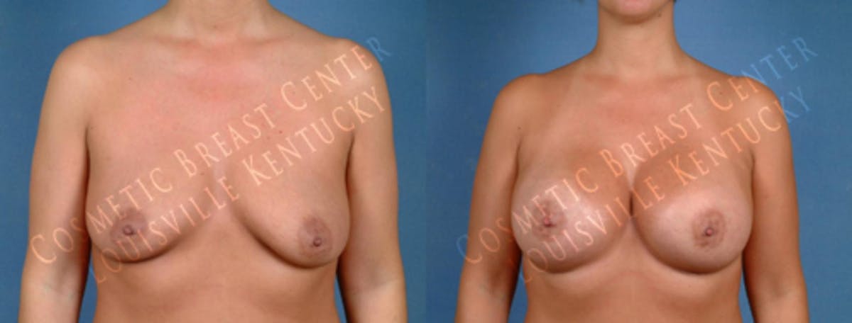 Enlargement - Saline Before & After Gallery - Patient 108650 - Image 1