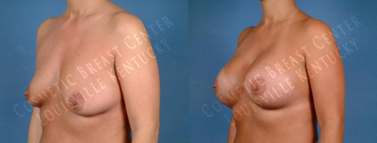 Enlargement - Saline Before & After Gallery - Patient 108650 - Image 2