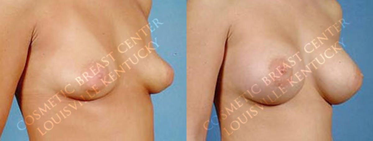 Enlargement - Saline Before & After Gallery - Patient 413086 - Image 2