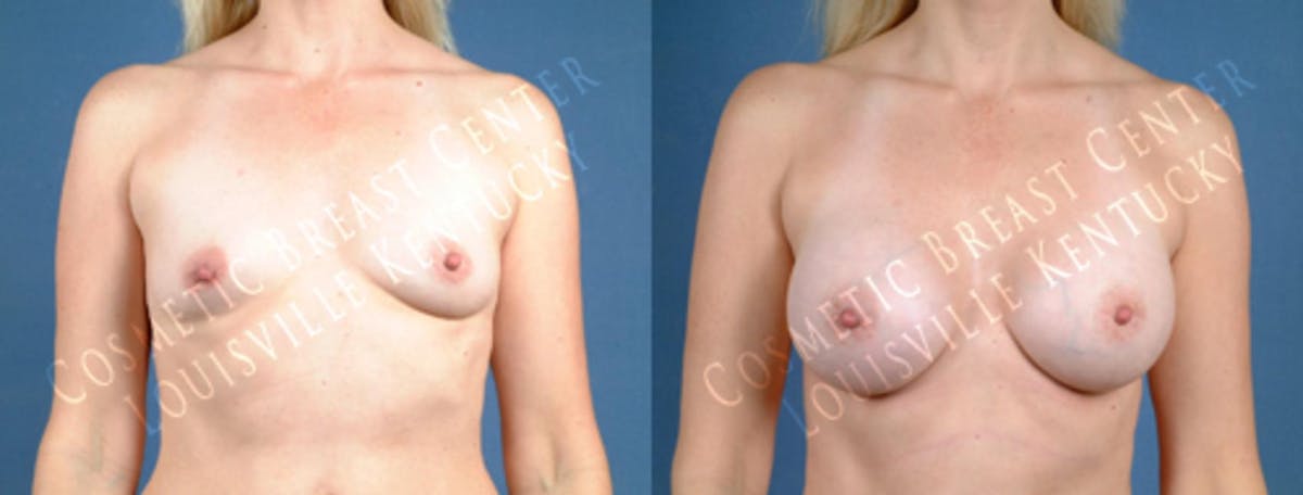 Enlargement - Saline Before & After Gallery - Patient 128625 - Image 1