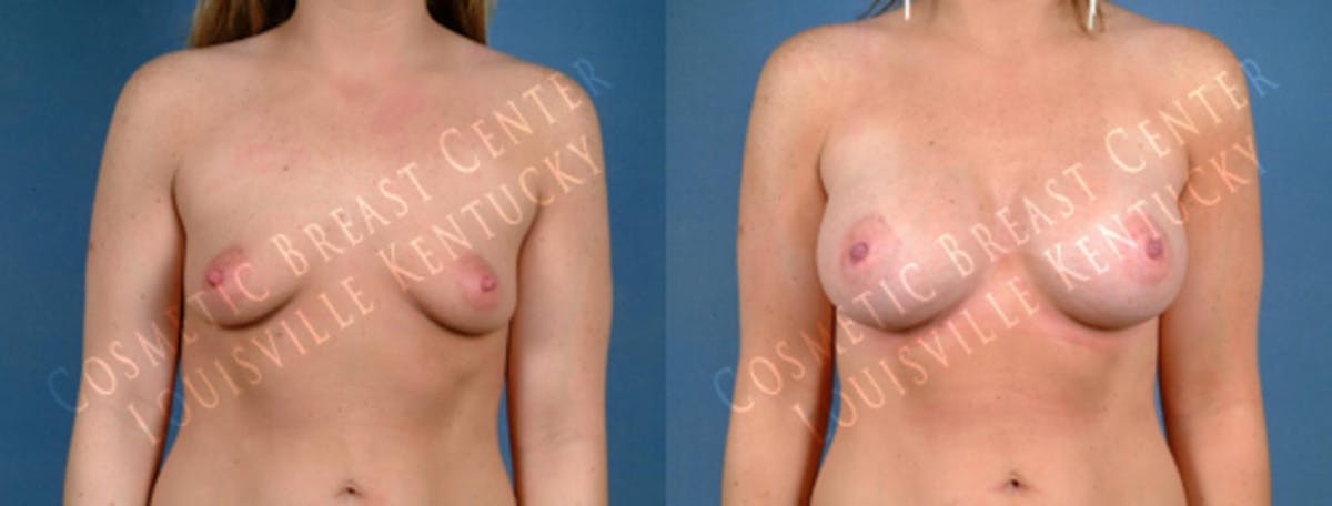 Enlargement - Saline Before & After Gallery - Patient 416175 - Image 1