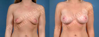 Enlargement - Saline Before & After Gallery - Patient 416175 - Image 1
