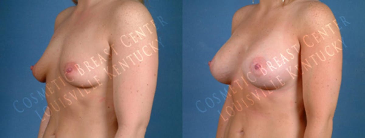 Enlargement - Saline Before & After Gallery - Patient 416175 - Image 2
