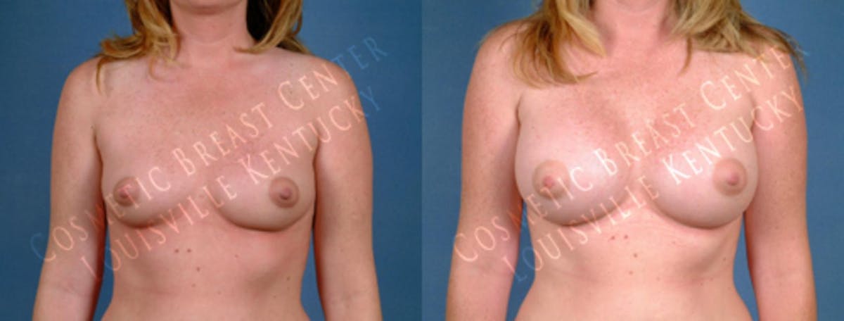 Enlargement - Saline Before & After Gallery - Patient 215334 - Image 1
