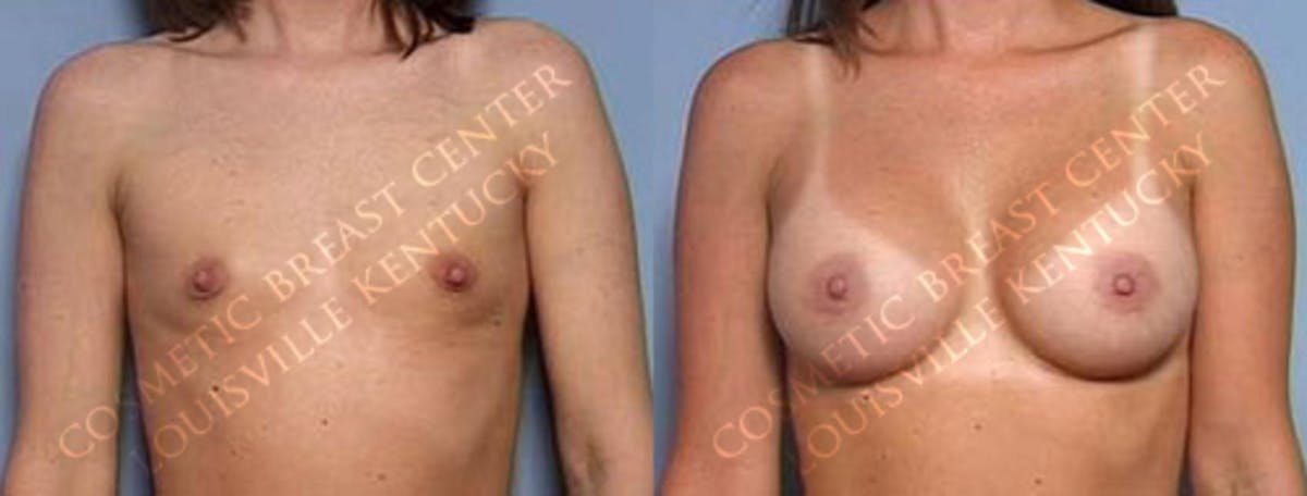 Enlargement - Saline Before & After Gallery - Patient 415627 - Image 1