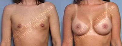 Enlargement - Saline Before & After Gallery - Patient 415627 - Image 1