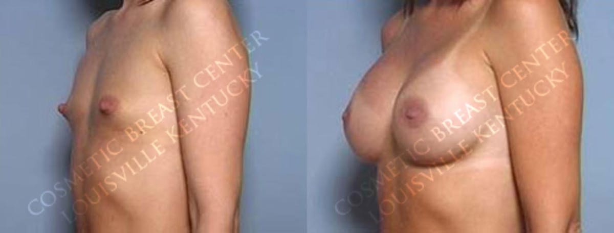 Enlargement - Saline Before & After Gallery - Patient 415627 - Image 2