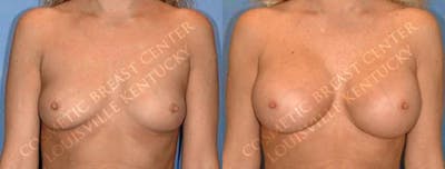 Enlargement - Saline Before & After Gallery - Patient 306297 - Image 1