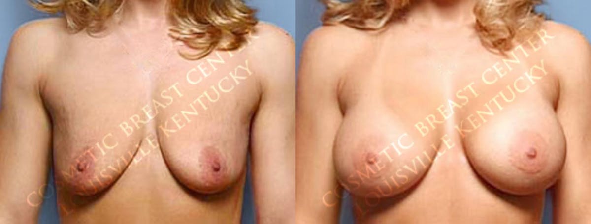 Enlargement - Saline Before & After Gallery - Patient 160406 - Image 1