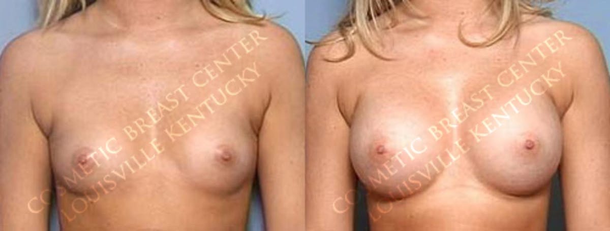 Enlargement - Saline Before & After Gallery - Patient 235440 - Image 1