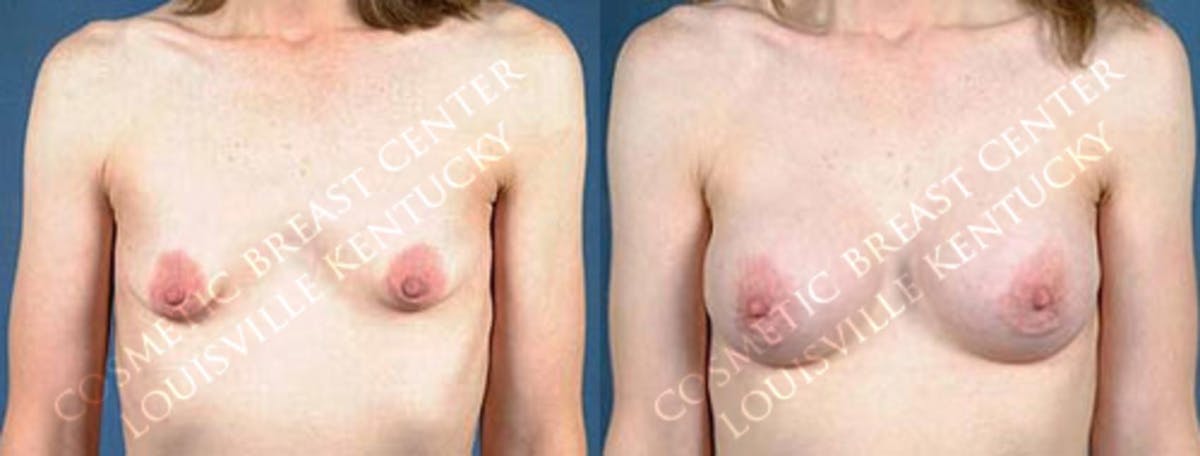 Enlargement - Saline Before & After Gallery - Patient 246127 - Image 1