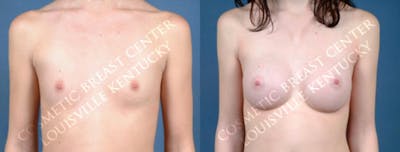 Enlargement - Saline Before & After Gallery - Patient 409146 - Image 1