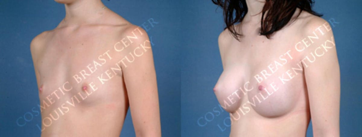 Enlargement - Saline Before & After Gallery - Patient 409146 - Image 2