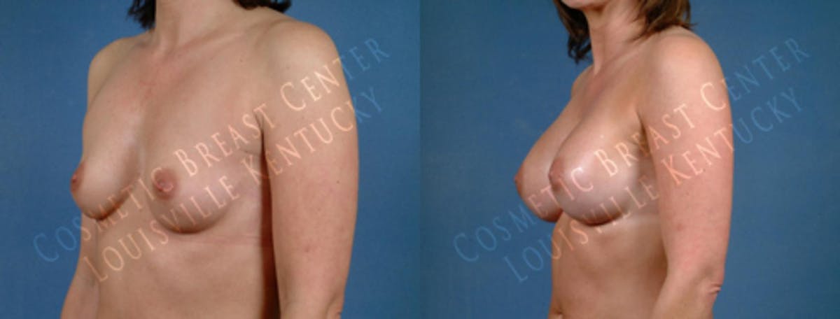 Enlargement - Saline Before & After Gallery - Patient 210893 - Image 2