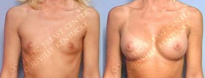 Enlargement - Saline Before & After Gallery - Patient 183854 - Image 1
