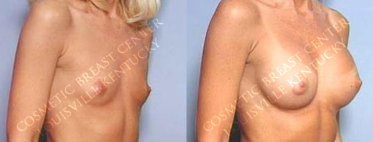 Enlargement - Saline Before & After Gallery - Patient 183854 - Image 2