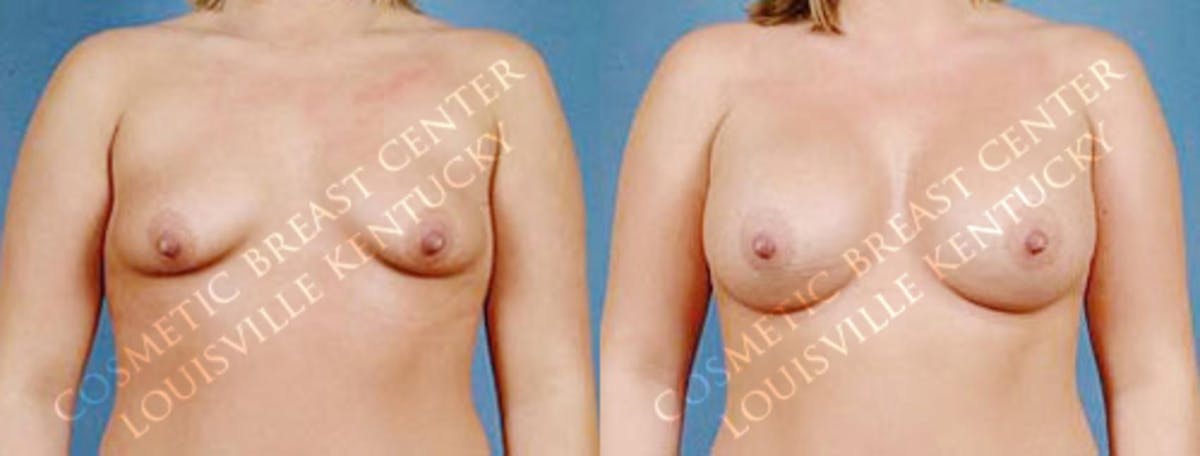 Enlargement - Saline Before & After Gallery - Patient 101348 - Image 1
