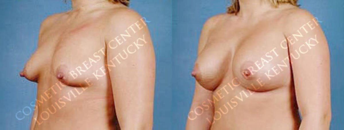 Enlargement - Saline Before & After Gallery - Patient 101348 - Image 2