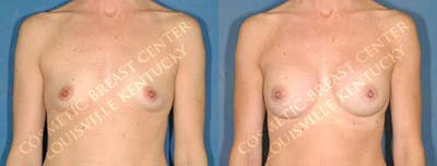 Enlargement - Saline Before & After Gallery - Patient 418812 - Image 1