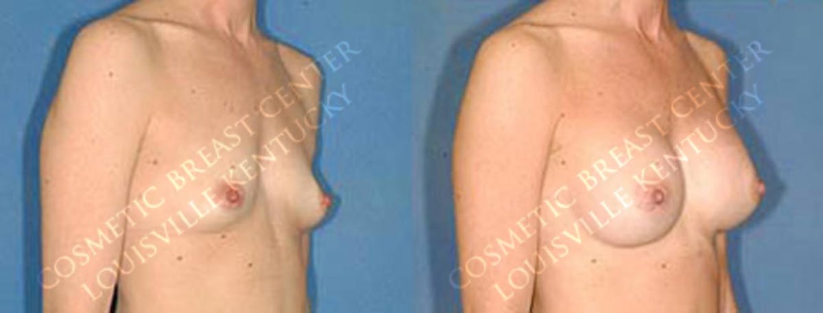Enlargement - Saline Before & After Gallery - Patient 418812 - Image 2