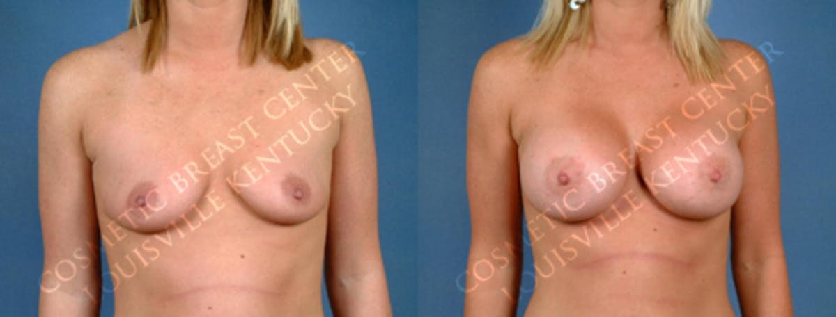 Enlargement - Saline Before & After Gallery - Patient 246459 - Image 1
