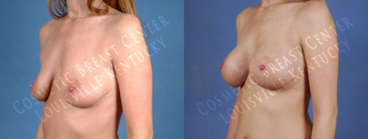 Enlargement - Saline Before & After Gallery - Patient 125780 - Image 2