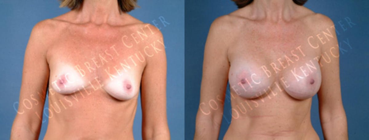 Enlargement - Saline Before & After Gallery - Patient 382811 - Image 1