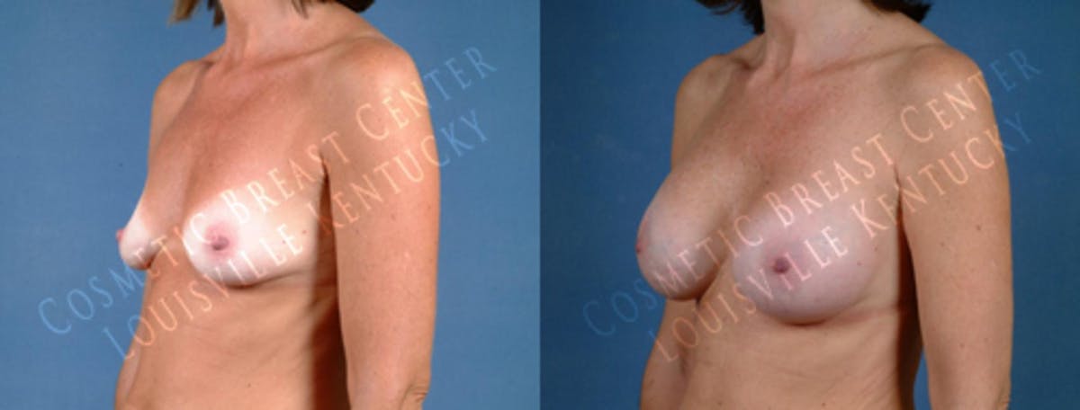 Enlargement - Saline Before & After Gallery - Patient 382811 - Image 2