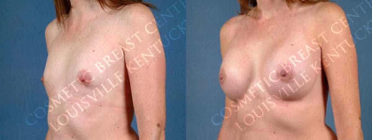 Enlargement - Silicone Before & After Gallery - Patient 408735 - Image 2