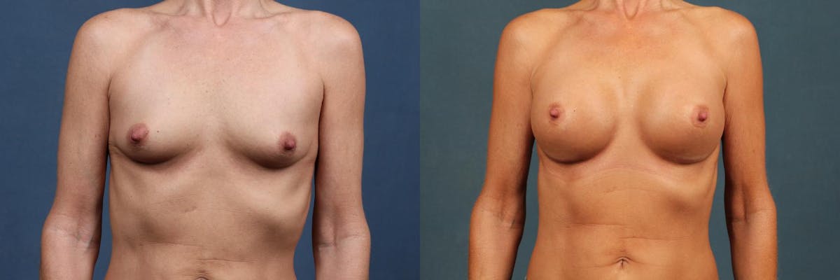 Enlargement - Silicone Before & After Gallery - Patient 381210 - Image 1