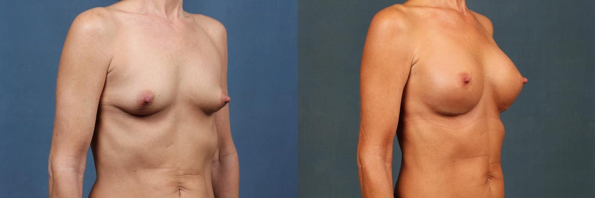 Enlargement - Silicone Before & After Gallery - Patient 381210 - Image 2