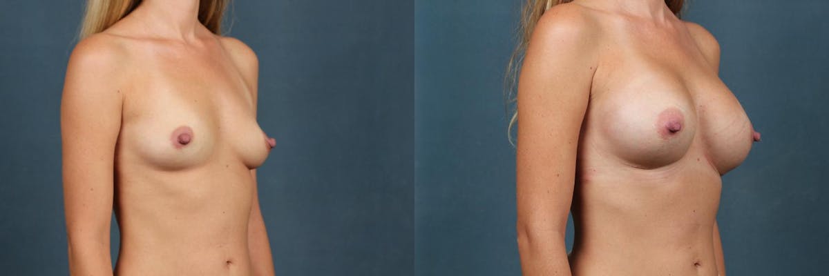 Enlargement - Silicone Before & After Gallery - Patient 403160 - Image 2