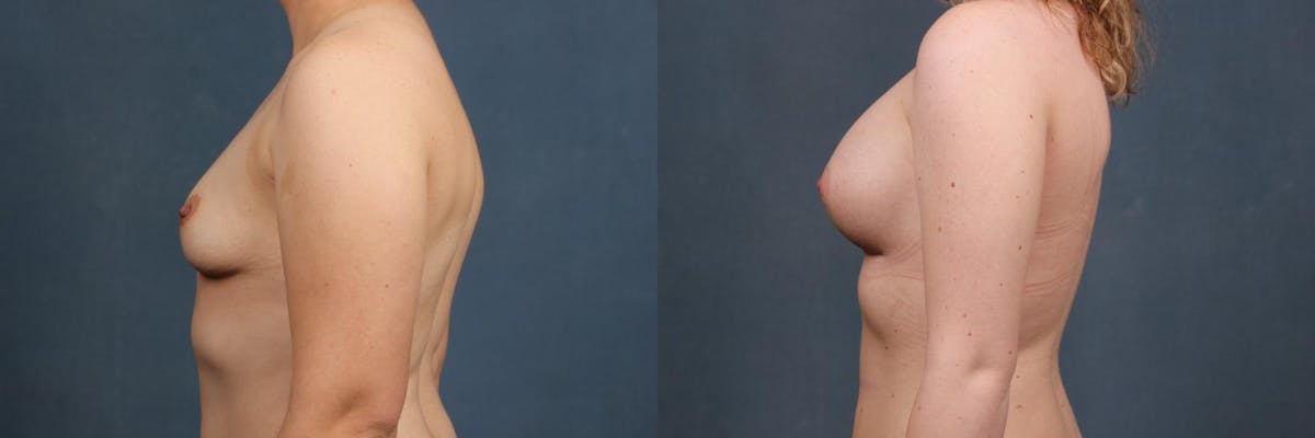 Enlargement - Silicone Before & After Gallery - Patient 287358 - Image 3