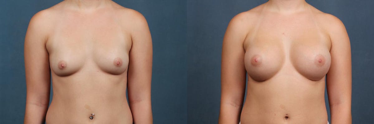 Enlargement - Silicone Before & After Gallery - Patient 242232 - Image 1