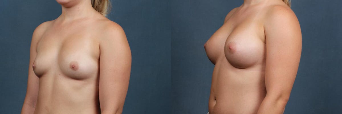 Enlargement - Silicone Before & After Gallery - Patient 242232 - Image 3