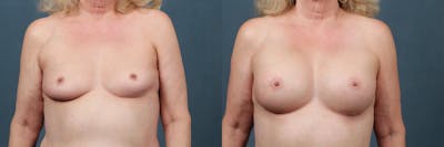 Enlargement - Silicone Before & After Gallery - Patient 376103 - Image 1