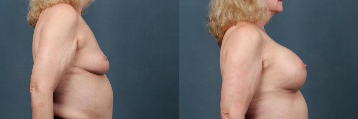 Enlargement - Silicone Before & After Gallery - Patient 376103 - Image 3