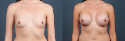 Enlargement - Silicone Before & After Gallery - Patient 201874 - Image 1