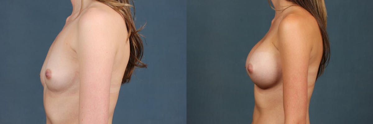 Enlargement - Silicone Before & After Gallery - Patient 201874 - Image 3