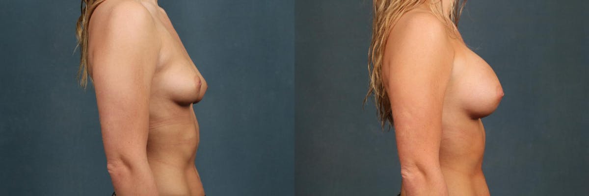 Enlargement - Silicone Before & After Gallery - Patient 314972 - Image 3