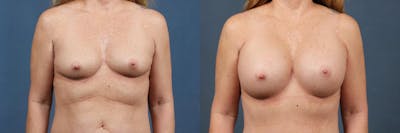 Enlargement - Silicone Before & After Gallery - Patient 257433 - Image 1