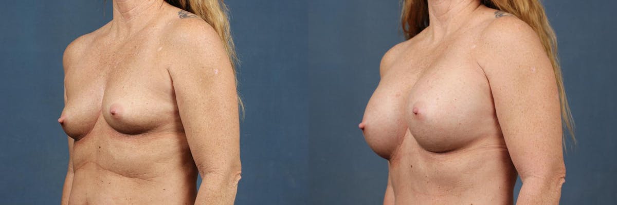Enlargement - Silicone Before & After Gallery - Patient 257433 - Image 2