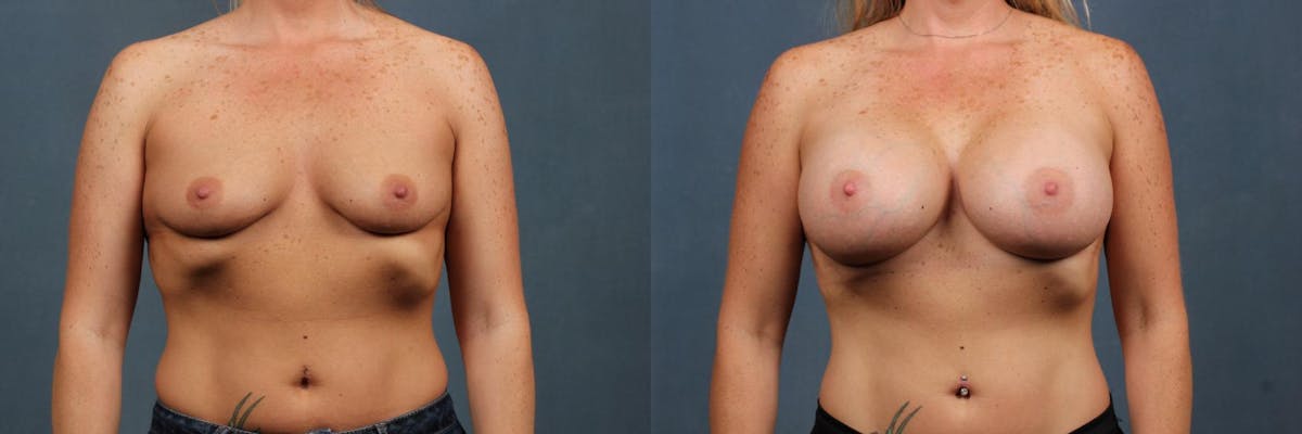 Enlargement - Silicone Before & After Gallery - Patient 174142 - Image 1