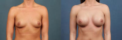 Enlargement - Silicone Before & After Gallery - Patient 338529 - Image 1