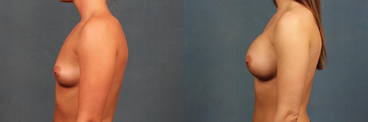 Enlargement - Silicone Before & After Gallery - Patient 338529 - Image 3