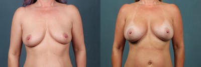 Enlargement - Silicone Before & After Gallery - Patient 124154 - Image 1