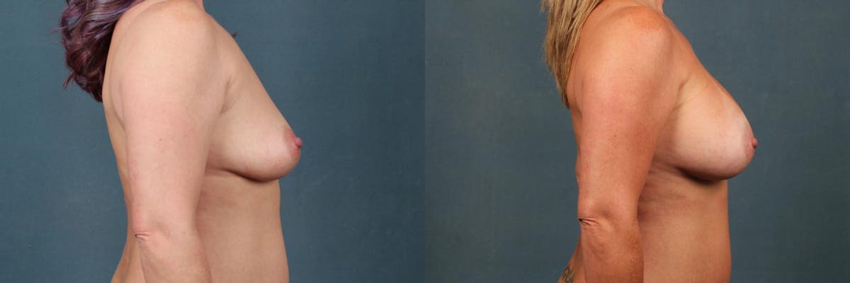 Enlargement - Silicone Before & After Gallery - Patient 124154 - Image 3