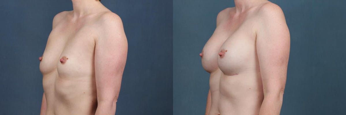 Enlargement - Silicone Before & After Gallery - Patient 168645 - Image 2