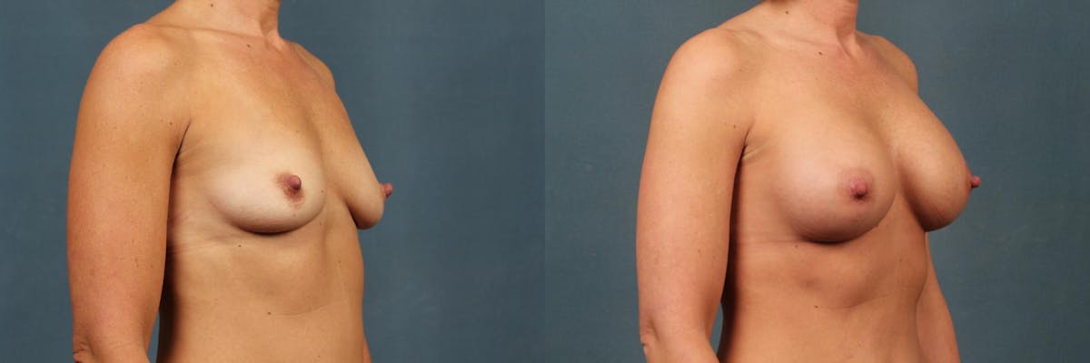 Enlargement - Silicone Before & After Gallery - Patient 315327 - Image 2