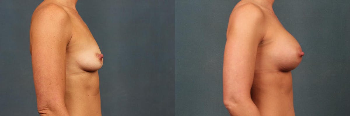 Enlargement - Silicone Before & After Gallery - Patient 315327 - Image 3